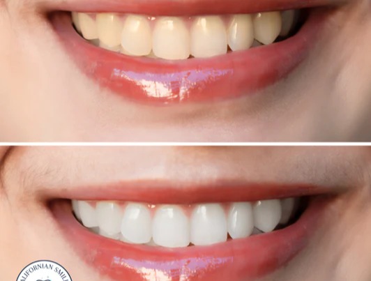 Quel est le meilleur kit de blanchiment dentaire ?